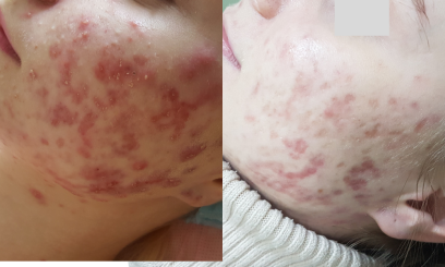 Лечебная чистка + химический пилинг по проблеме  4